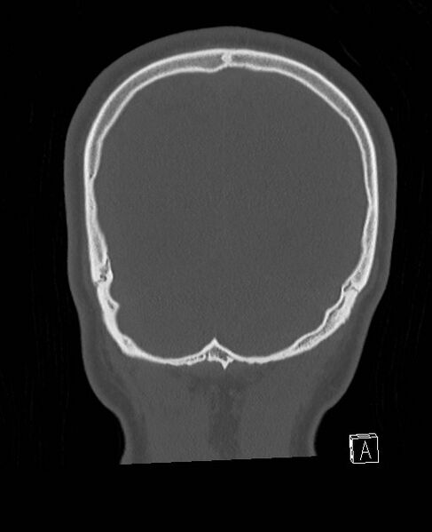 File:Base of skull fracture with bilateral Le Fort fractures (Radiopaedia 47094-51638 Coronal bone window 17).jpg