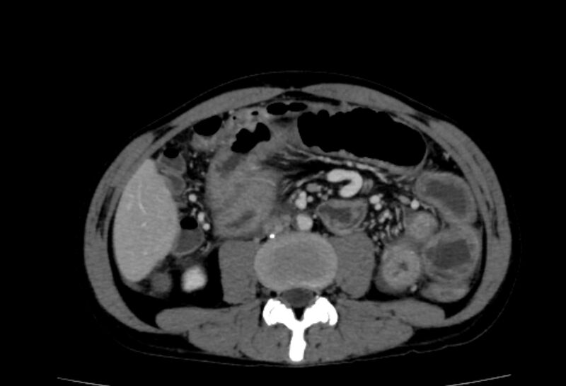 File:Behçet's disease- abdominal vasculitis (Radiopaedia 55955-62570 A 42).jpg