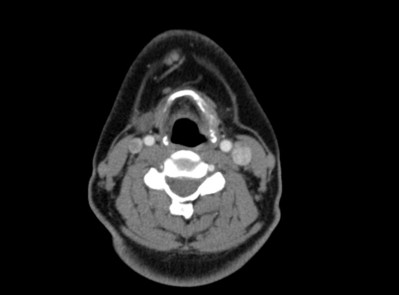 File:Benign mixed salivary tumor of the parotid gland (Radiopaedia 35261-36792 A 31).jpg