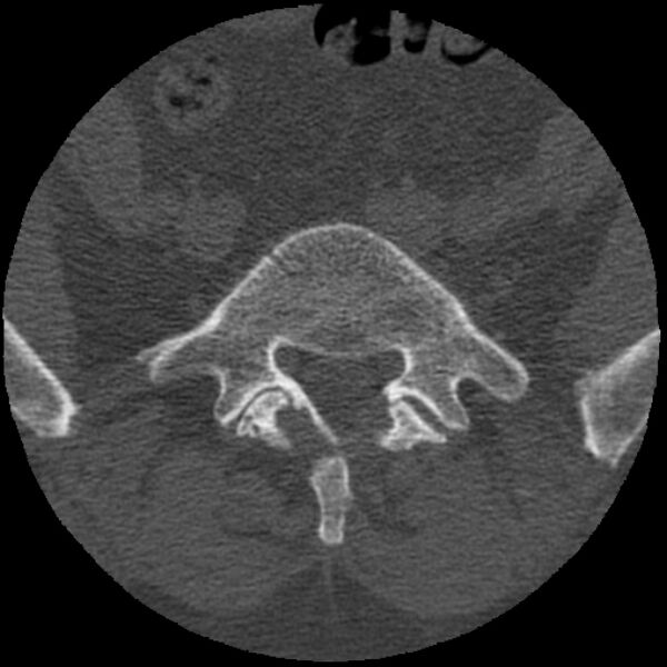 File:Bertolotti syndrome (Radiopaedia 24864-25128 Axial bone window 7).jpg