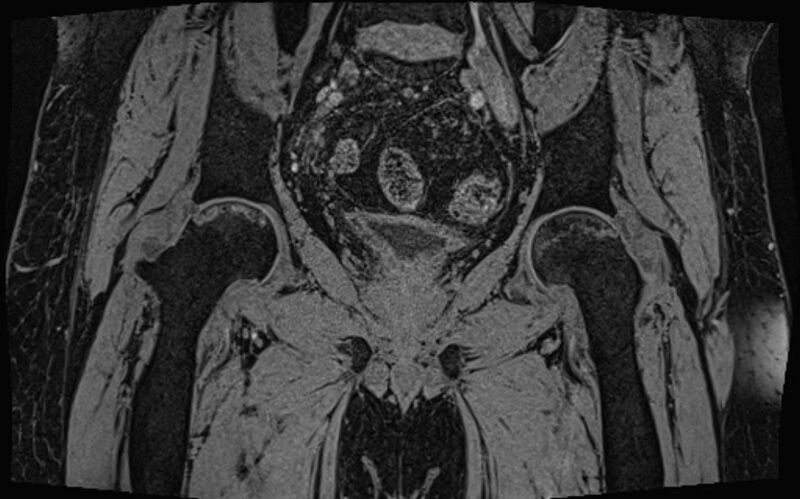 File:Bilateral avascular necrosis of femoral head (Radiopaedia 77116-89078 Coronal T2 we 37).jpg