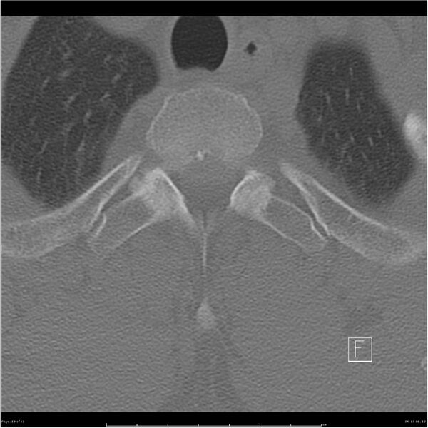 File:Bilateral cervical ribs (Radiopaedia 25868-26017 Axial bone window 53).jpg
