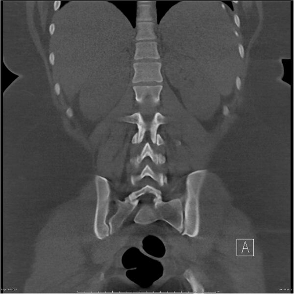 File:Bilateral lumbar ribs (Radiopaedia 25862-26010 Coronal bone window 14).jpg