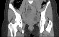 Bilateral mature cystic ovarian teratoma (Radiopaedia 88821-105592 Coronal non-contrast 12).jpg