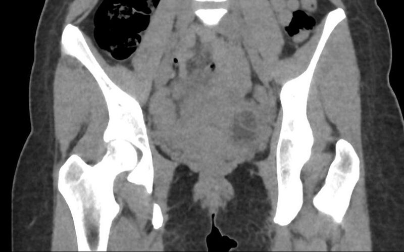 File:Bilateral mature cystic ovarian teratoma (Radiopaedia 88821-105592 Coronal non-contrast 12).jpg