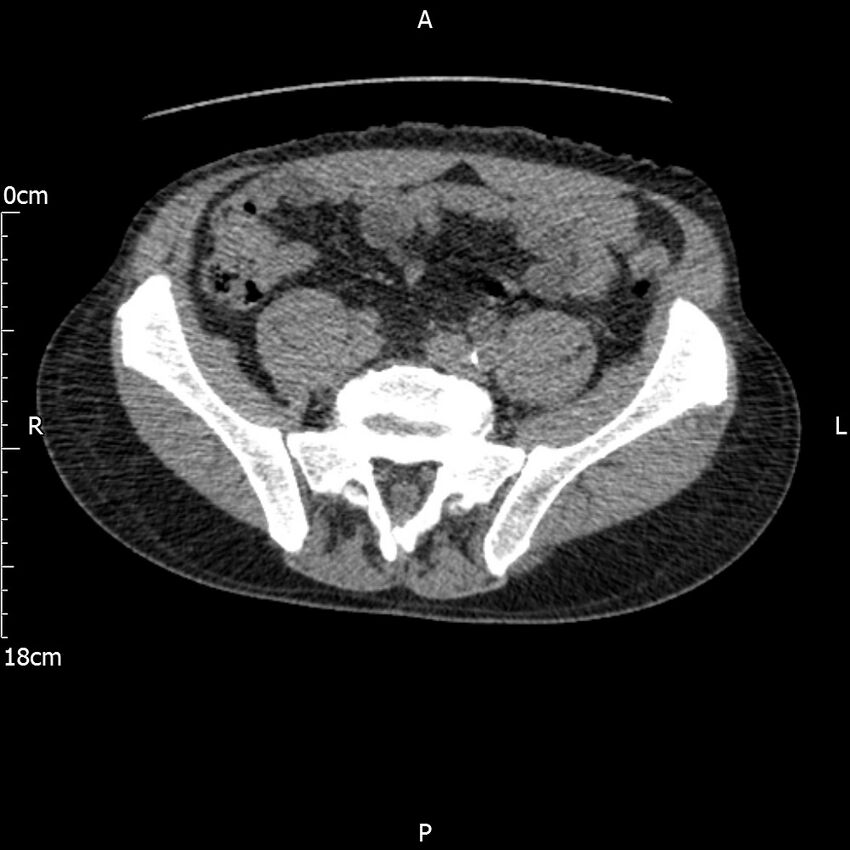 Bilateral medullary nephrocalcinosis with ureteric calculi (Radiopaedia 71269-81569 Axial non-contrast 93).jpg