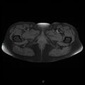Bilateral ovarian fibroma (Radiopaedia 44568-48293 Axial T1 fat sat 31).jpg