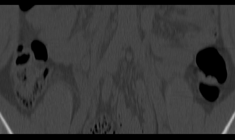 File:Bilateral pars defect (Radiopaedia 26691-26846 Coronal bone window 1).jpg