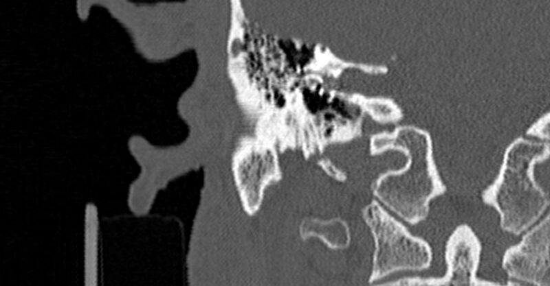 File:Bilateral temporal bone fractures (Radiopaedia 29482-29970 Coronal non-contrast 117).jpg