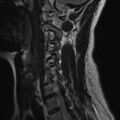 Bilateral tortuous vertebral arteries (Radiopaedia 19070-19039 Sagittal T2 7).jpg