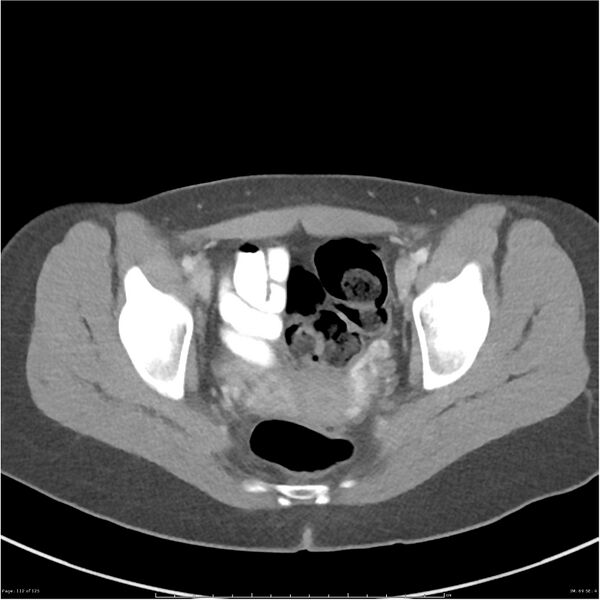 File:Bilateral ureteritis and cystitis (Radiopaedia 25340-25594 A 69).jpg