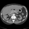 Biliary necrosis - liver transplant (Radiopaedia 21876-21845 A 23).jpg