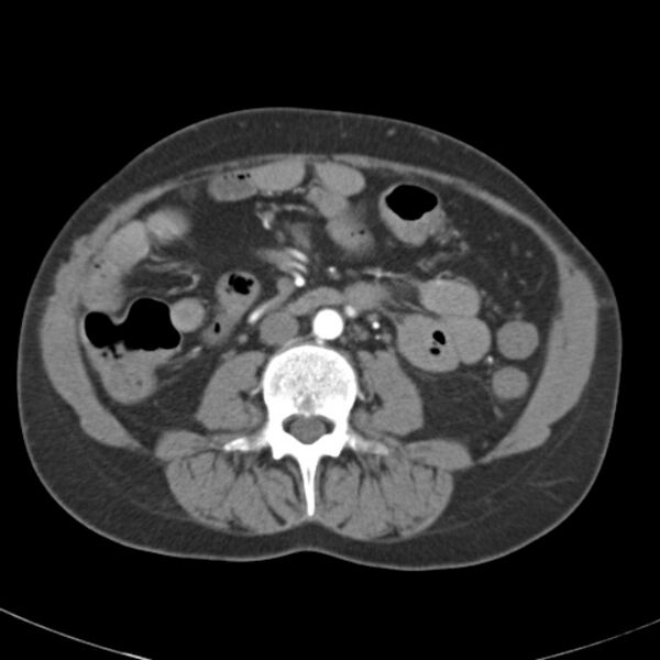File:Biliary necrosis - liver transplant (Radiopaedia 21876-21845 A 34).jpg