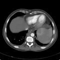 Biliary necrosis - liver transplant (Radiopaedia 21876-21846 A 7).jpg