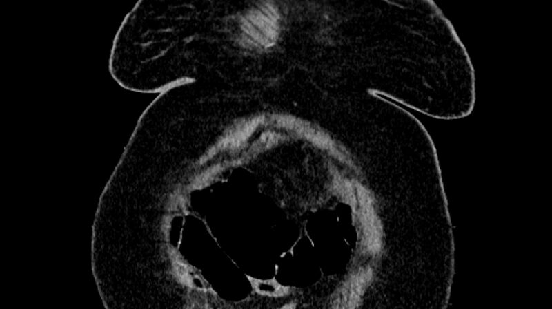 File:Biliary pancreatitis (Radiopaedia 72289-82823 Coronal non-contrast 5).jpg