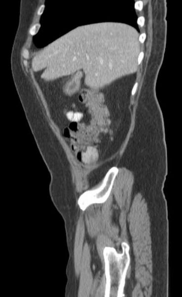 File:Bleeding duodenal ulcer and adenomyomatosis of gallbladder (Radiopaedia 61834-69861 C 16).jpg