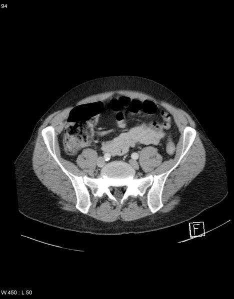 File:Boerhaave syndrome with tension pneumothorax (Radiopaedia 56794-63603 A 47).jpg