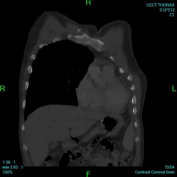 File:Bone metastases from lung carcinoma (Radiopaedia 54703-60937 Coronal bone window 15).jpg