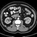 Bosniak cyst - type IV (Radiopaedia 23525-23627 renal cortical phase 30).jpg