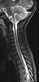 Brachial plexus birth palsy (Radiopaedia 68118-77604 Sagittal T2 8).jpg