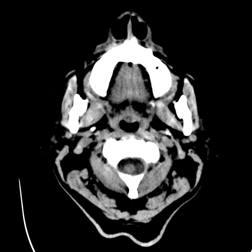 Brain Pantopaque remnants (Radiopaedia 78403-91048 Axial non-contrast 3).jpg