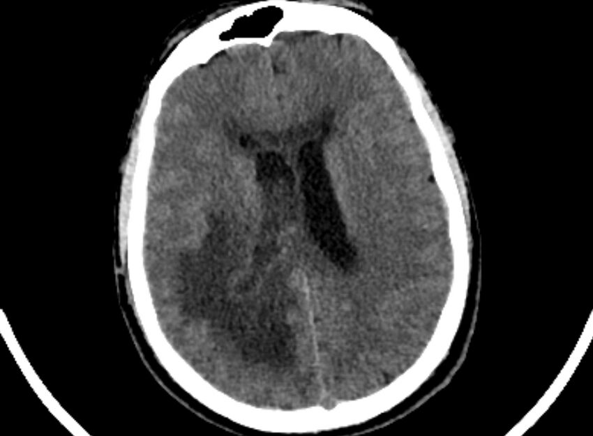 Brain abscess complicated by intraventricular rupture and ventriculitis (Radiopaedia 82434-96575 Axial non-contrast 66).jpg