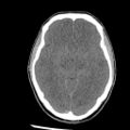 Brain death (Radiopaedia 78597-91360 Axial non-contrast 29).jpg