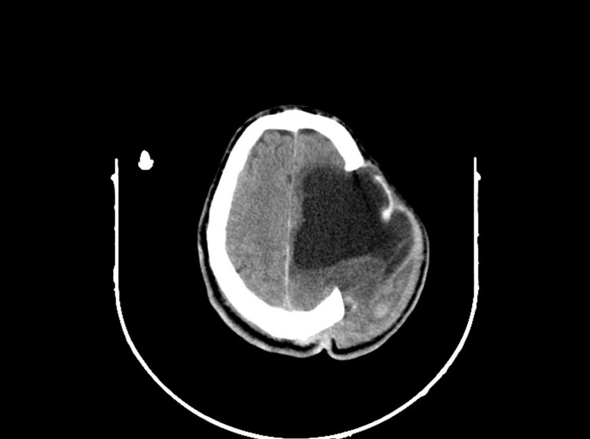Brain injury by firearm projectile (Radiopaedia 82068-96088 A 171).jpg