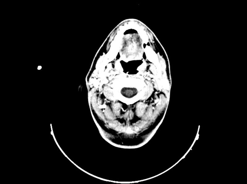 File:Brain injury by firearm projectile (Radiopaedia 82068-96088 B 48).jpg