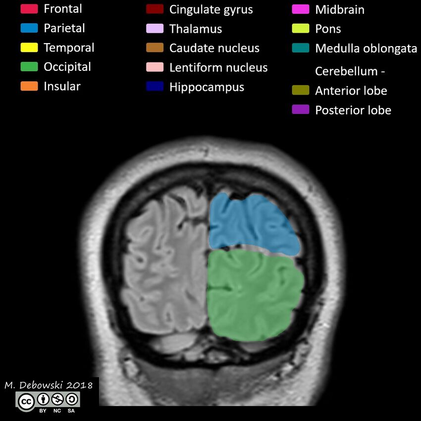 Brain lobes - annotated MRI (Radiopaedia 61691-69700 Coronal 66).JPG