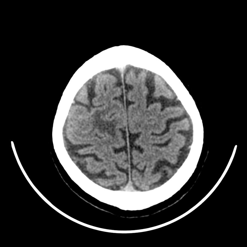Brain metastasis (Radiopaedia 42617-45760 Axial non-contrast 42).jpg