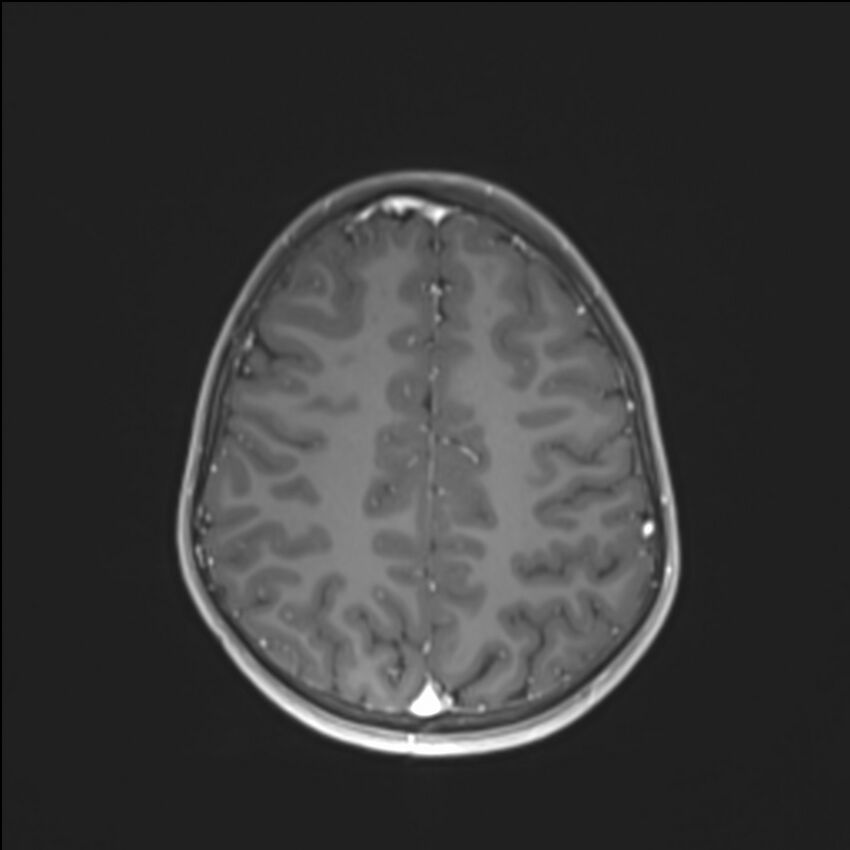 Brainstem glioma (Radiopaedia 70548-80674 Axial T1 C+ 116).jpg