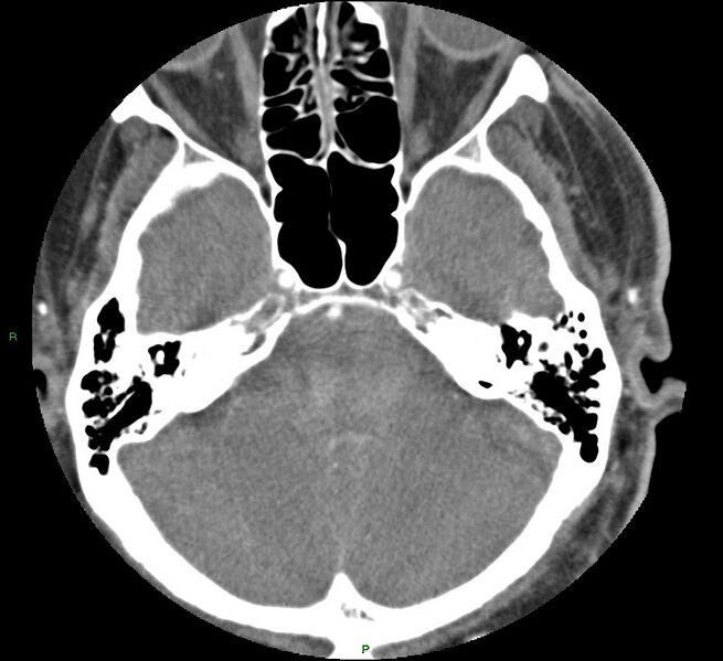 File:Brainstem hemorrhage (Radiopaedia 58794-66028 D 49).jpg