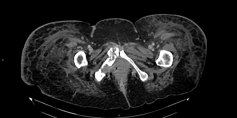 File:Breast cancer pelvic bony metastases (Radiopaedia 84470-99824 Axial bone window 76).jpg