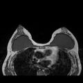 Breast implants - MRI (Radiopaedia 26864-27035 Axial T1 29).jpg