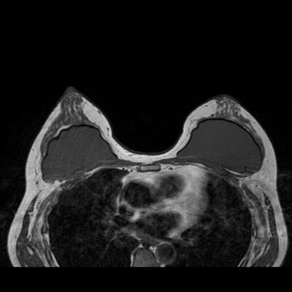 File:Breast implants - MRI (Radiopaedia 26864-27035 Axial T1 29).jpg