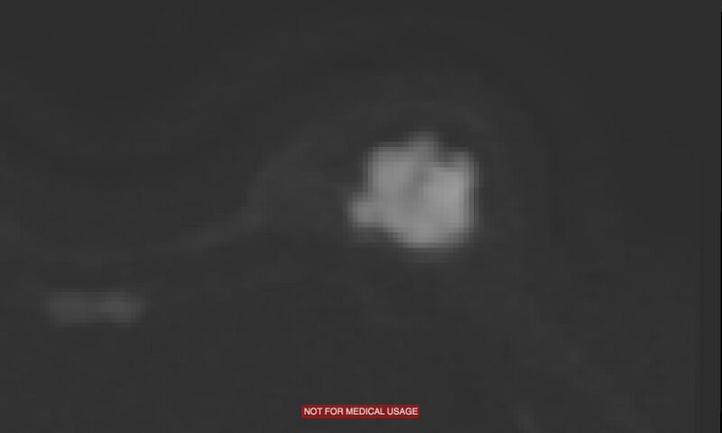 File:Breast lymphoma (MRI) (Radiopaedia 34999-36498 Axial DWI 8).jpg