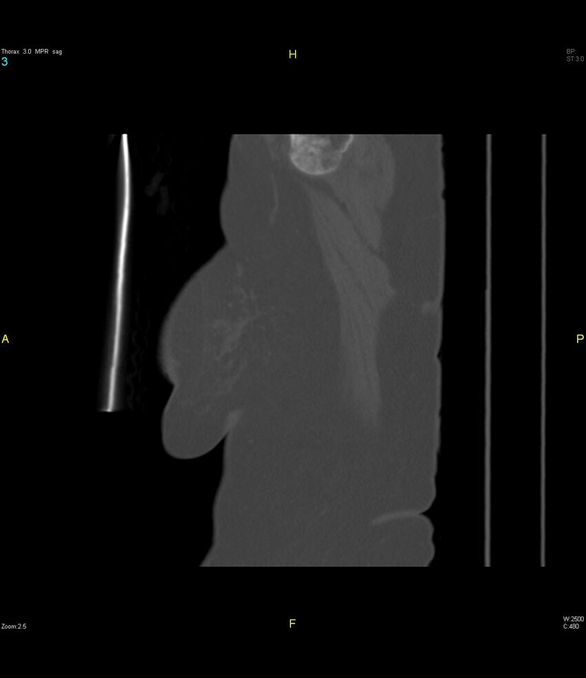 Breast primary with lung and bone metastases (Radiopaedia 40620-43228 Sagittal bone window 3).jpg