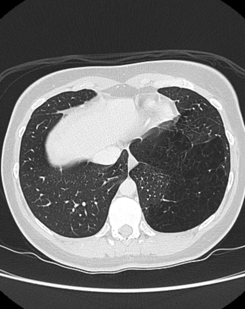 Bronchial atresia (Radiopaedia 50007-55297 Axial lung window 88).jpg