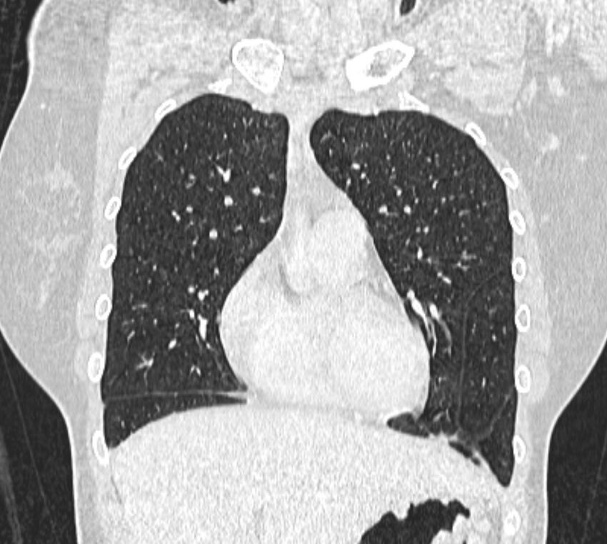 Bronchial atresia (Radiopaedia 50007-55297 Coronal lung window 27).jpg