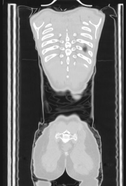 File:Bronchial carcinoid tumor (Radiopaedia 57187-64090 Coronal lung window 106).jpg