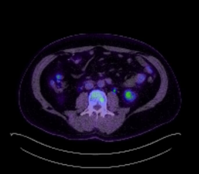 File:Bronchial carcinoid tumor (Radiopaedia 67377-76766 18FDG-PET-CT 46).jpg