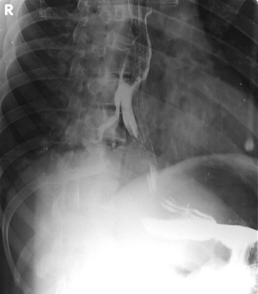 File:Broncho-esophageal fistula (Radiopaedia 29415-29886 A 1).jpg