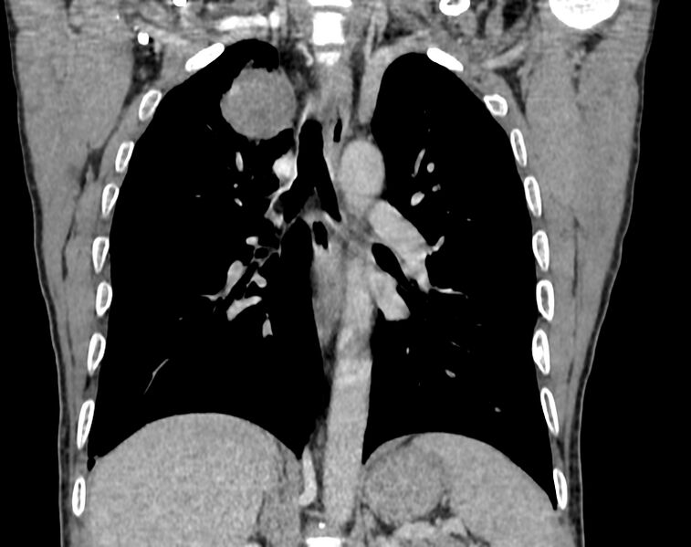 File:Bronchogenic carcinoma with superior vena cava syndrome (Radiopaedia 36497-38054 Coronal C+ delayed 63).jpg