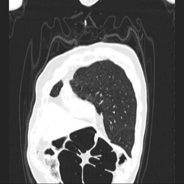 File:Bronchopleural fistula - postoperative complication (Radiopaedia 21020-20947 Coronal lung window 5).jpg