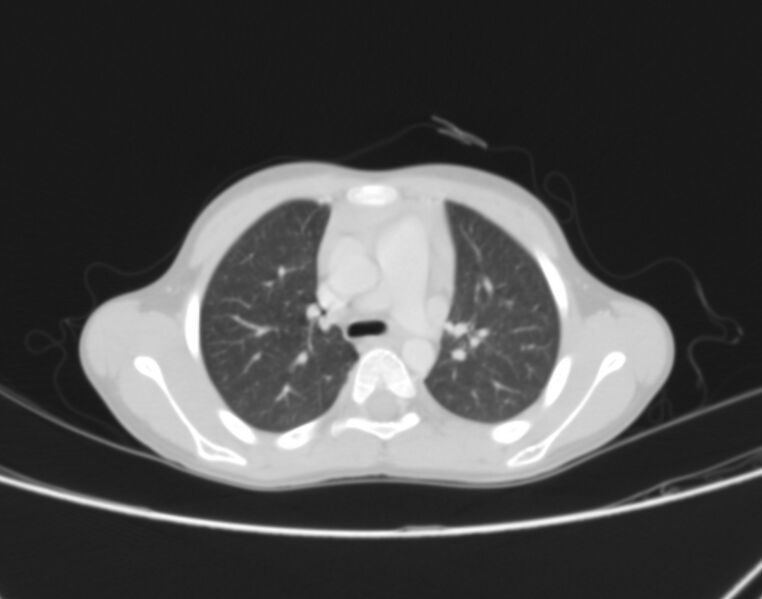 File:Bronchus suis (Radiopaedia 68131-77620 Axial lung window 24).jpg