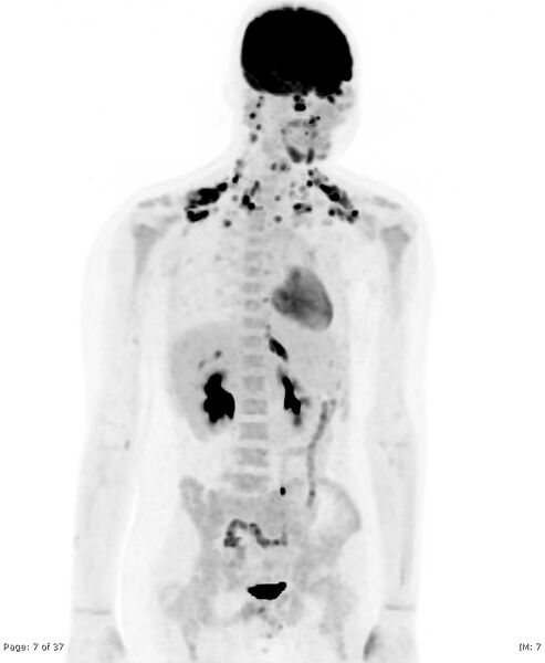 File:Brown fat uptake (FDG PET-CT) (Radiopaedia 77392-89513 MIP 6).jpg