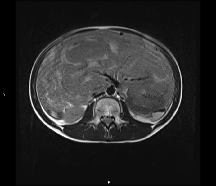 File:Burkitt lymphoma (bowel) (Radiopaedia 68839-78557 Axial T2 31).jpg