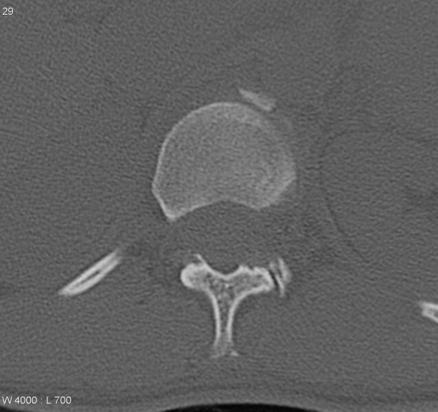 File:Burst fracture (Radiopaedia 5274-7018 Axial bone window 1).jpg