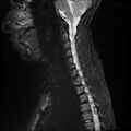 Butterfly vertebra (Radiopaedia 77903-90208 Sagittal STIR 8).jpg